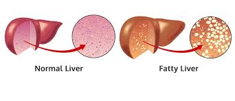 Diet for Fatty Liver